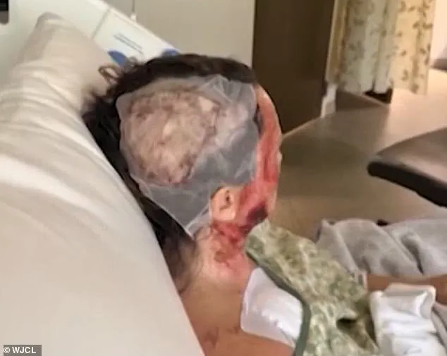 Severe Corrosive Attack in Savannah Park Leaves Woman with Extensive Burns, Highlighting Community Safety Risks