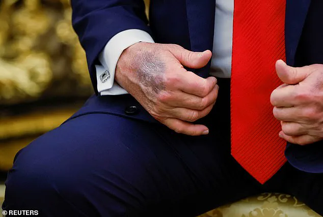 Trump Defies Medical Advice with High-Dose Aspirin Regimen, Experts Warn of Health Risks