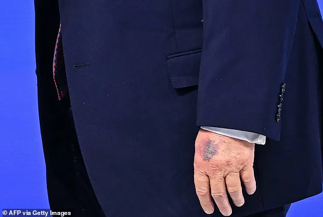 President Trump Reveals Bruise Sustained During Davos Event, Calls It a Simple Mishap